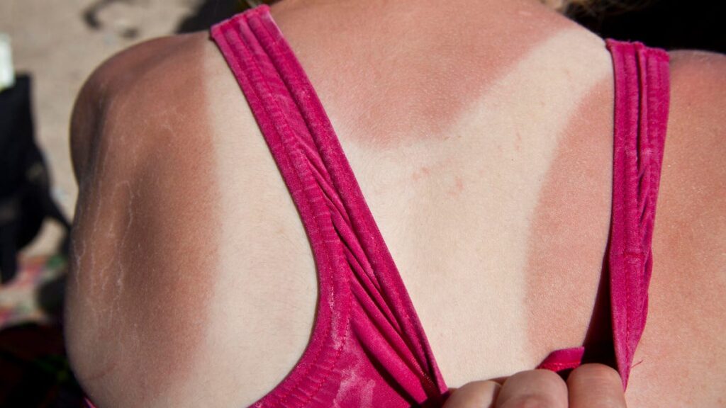 Sunburn and tan lines on skin